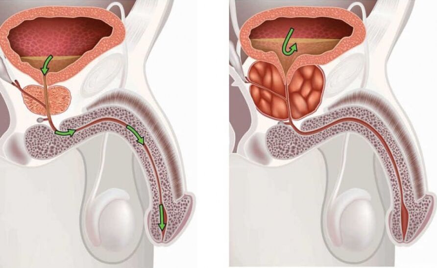 Impormasyon bahin sa sakit nga prostatitis