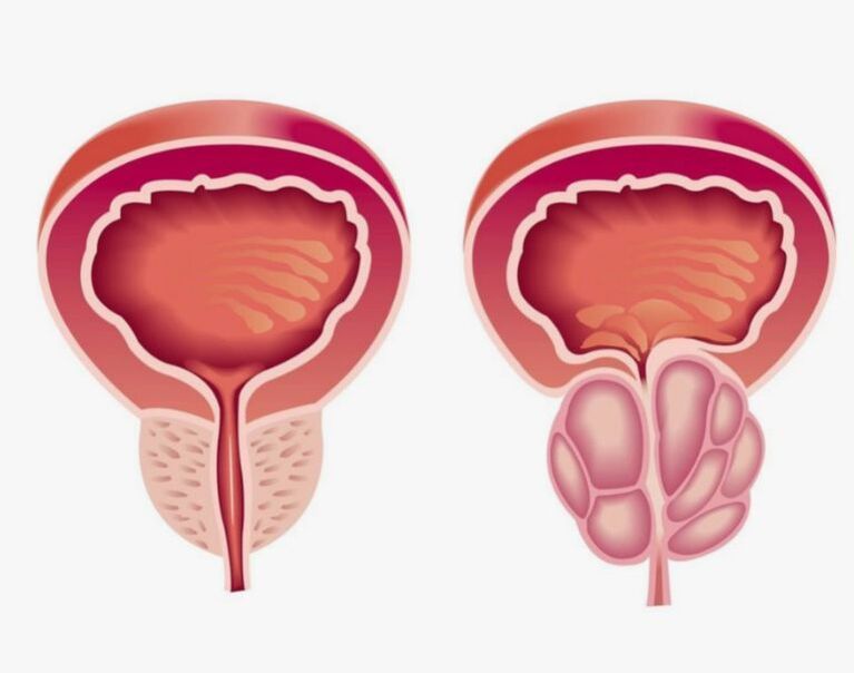 himsog ug masakiton nga prostate