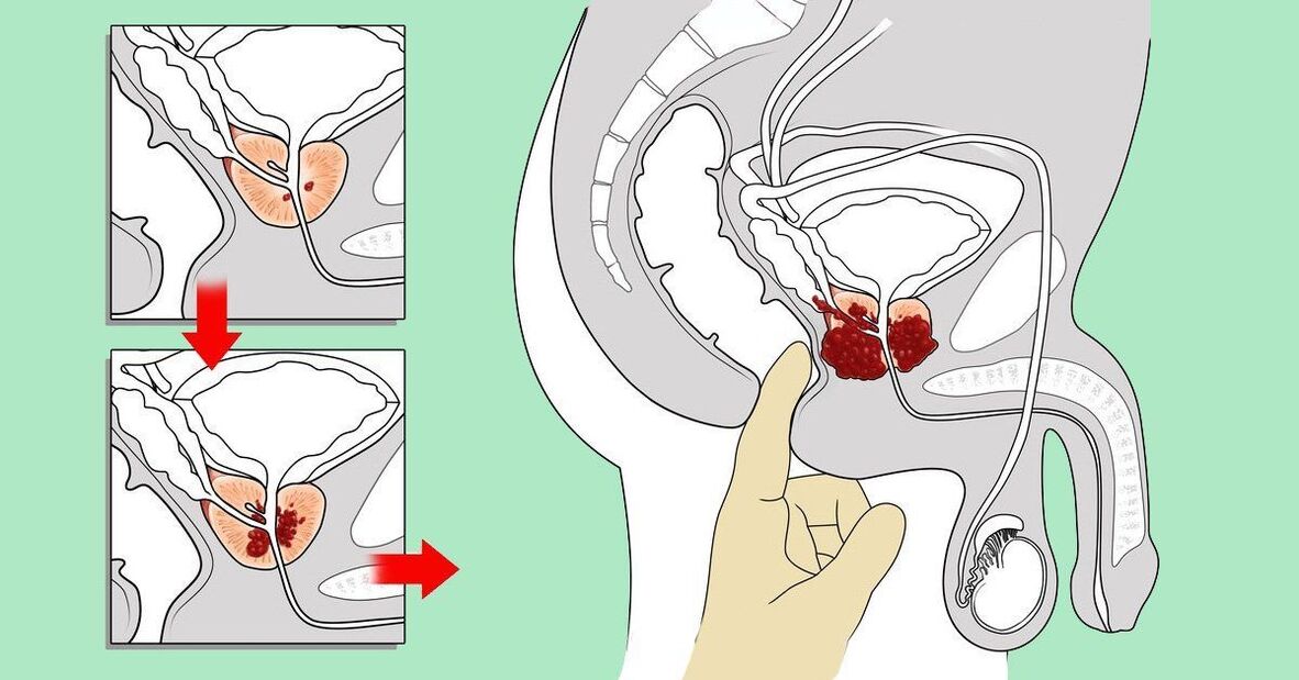 unsaon pagmasahe sa prostate